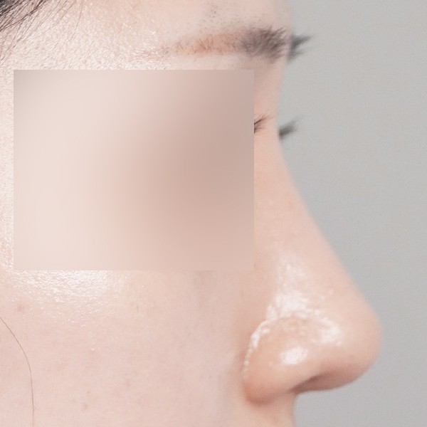 코끝,비중격,귀연골,매부리,복코,절골,비순각