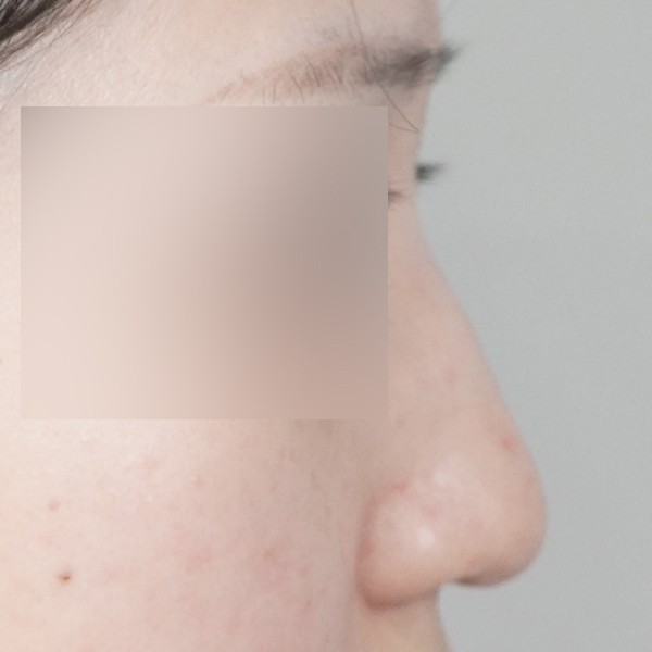 코끝,비중격,귀연골,매부리,복코,절골,비순각