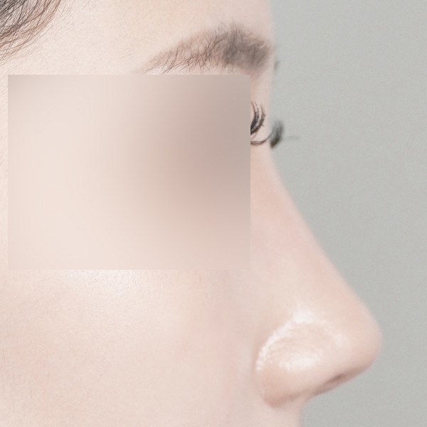 코끝,비중격,귀연골,매부리,복코,절골,비순각