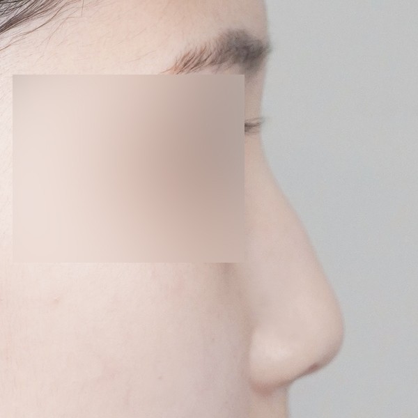 코끝,비중격,귀연골,매부리,복코,절골,비순각